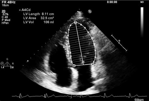 normal lv chamber size echo